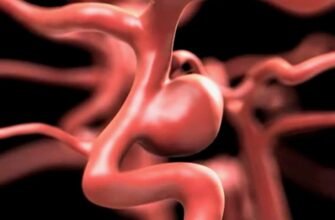 Розкриваємо суть аневризми: причини