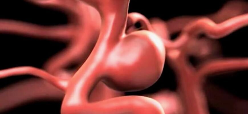 Розкриваємо суть аневризми: причини