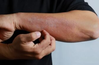 Що таке дерматит: причини