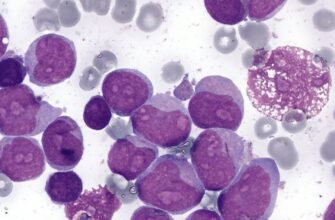 Що таке лейкемія: симптоми