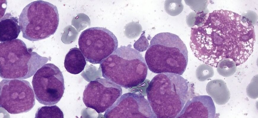 Що таке лейкемія: симптоми