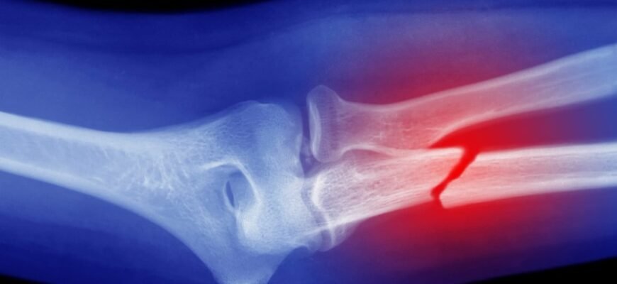 Розуміння Переломів Кісток: Причини