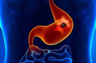 Глибоке розуміння виразки шлунка: причини