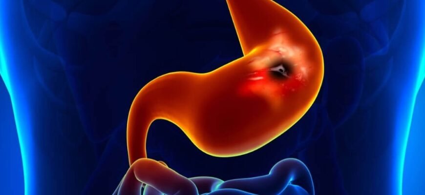Глибоке розуміння виразки шлунка: причини