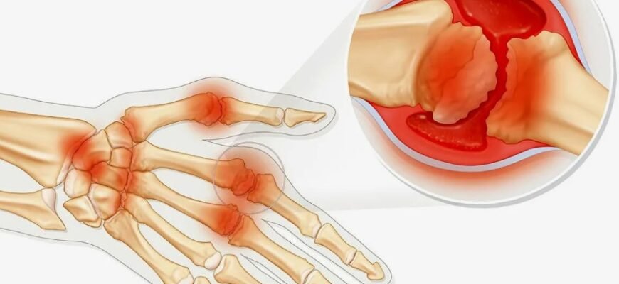 Артрит: що це таке