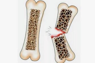 Що таке остеопороз: причини