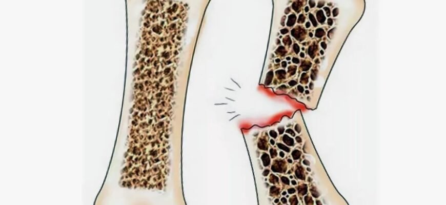 Що таке остеопороз: причини