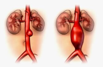 Що таке аневризма аорти: причини