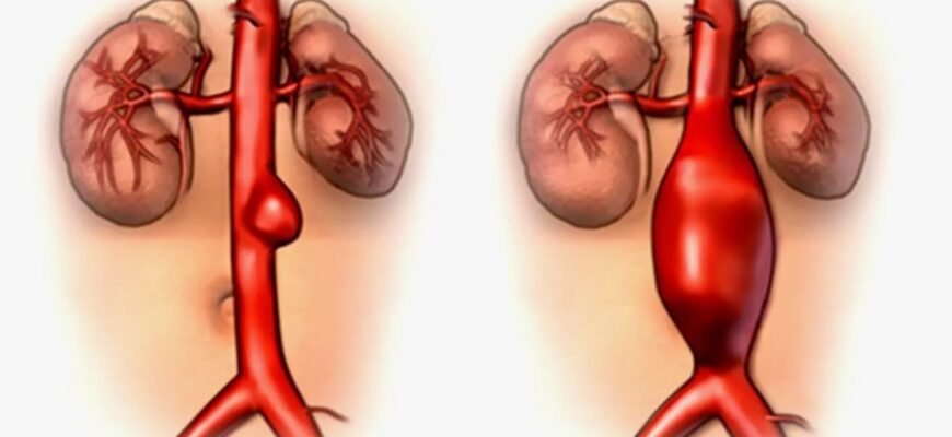 Що таке аневризма аорти: причини