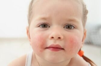 Що таке діатез: причини