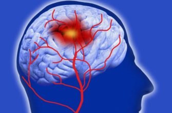 Геморагічний інсульт: причини