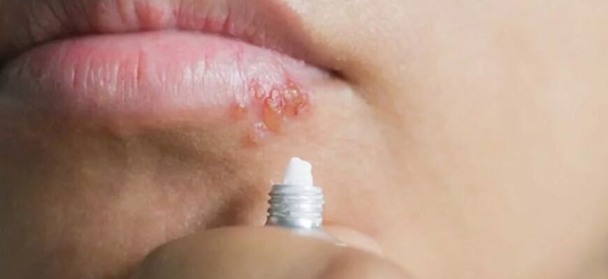 Ознайомлення з герпесом на губах: причини