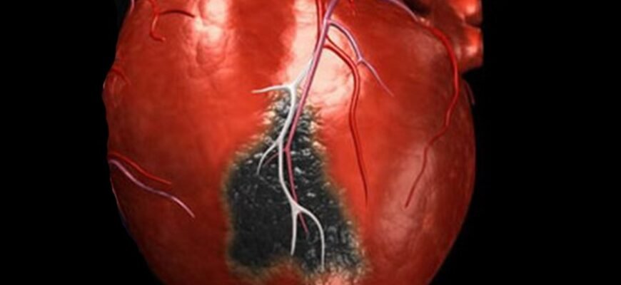 Інфаркт міокарда: ознаки