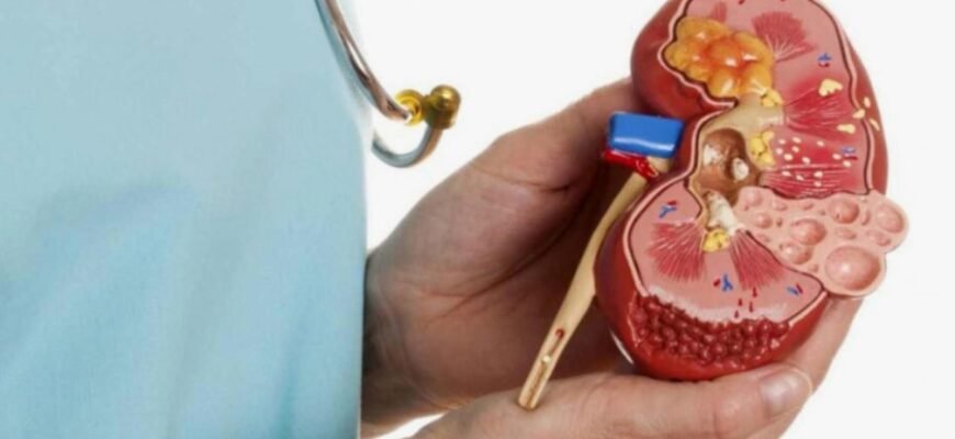 Кіста нирки: причини