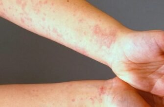 Що таке кропивниця: симптоми