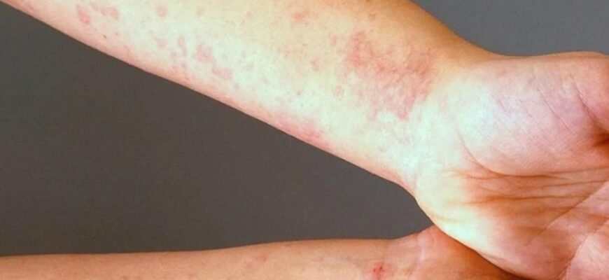 Що таке кропивниця: симптоми