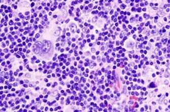 Лімфома Ходжкіна: Симптоми