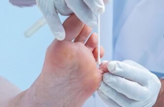 Визначення та симптоми мікозу: все