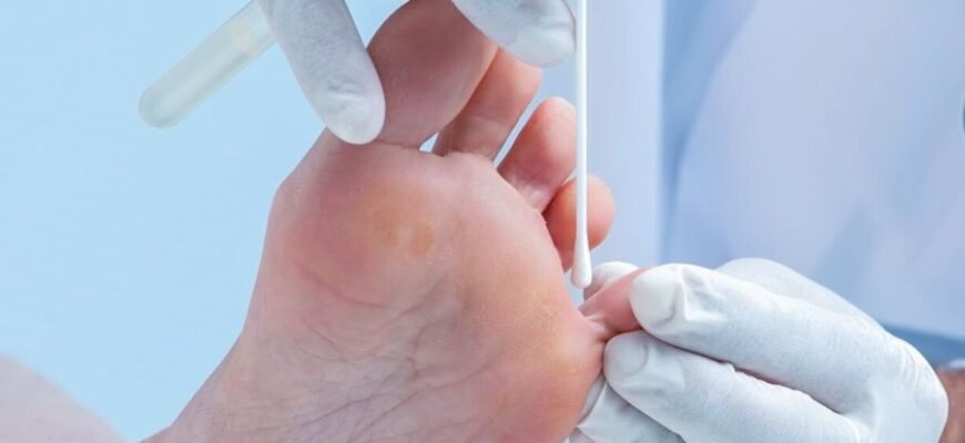 Визначення та симптоми мікозу: все