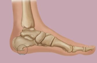 Що таке шпори на ногах: Причини